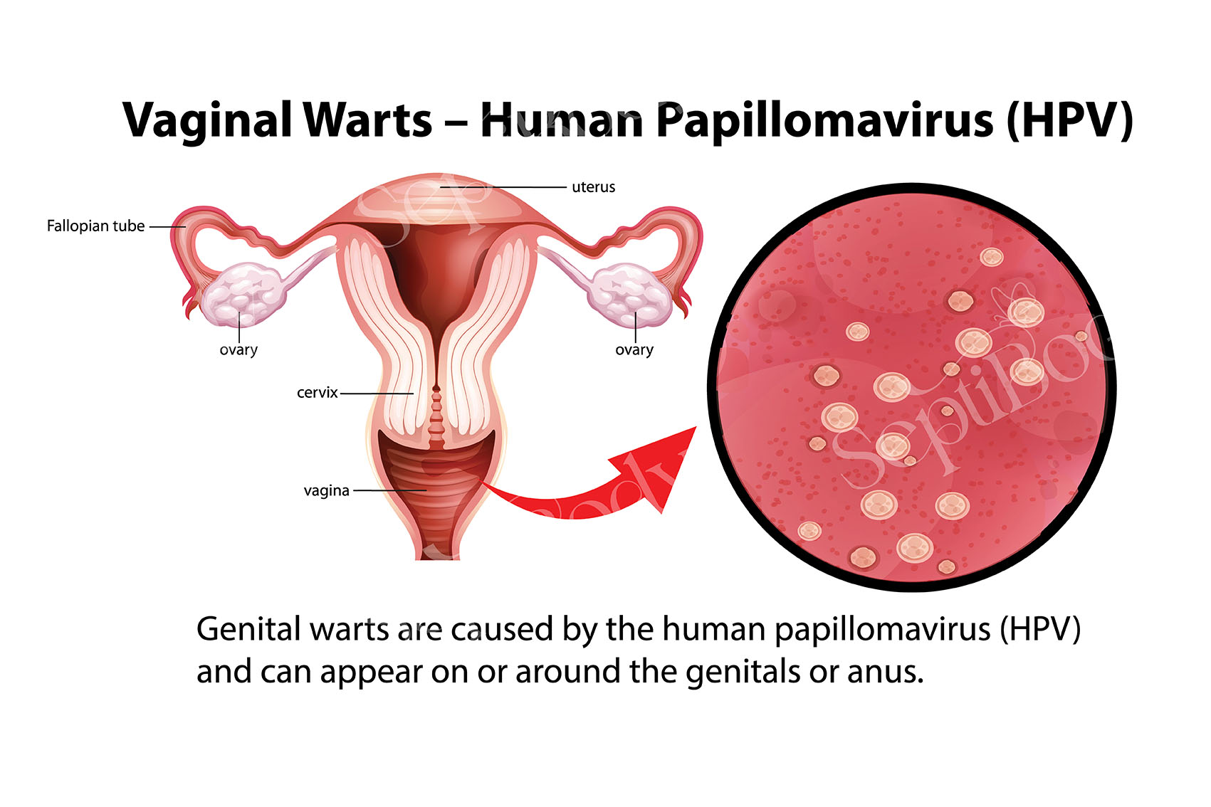 hpv
