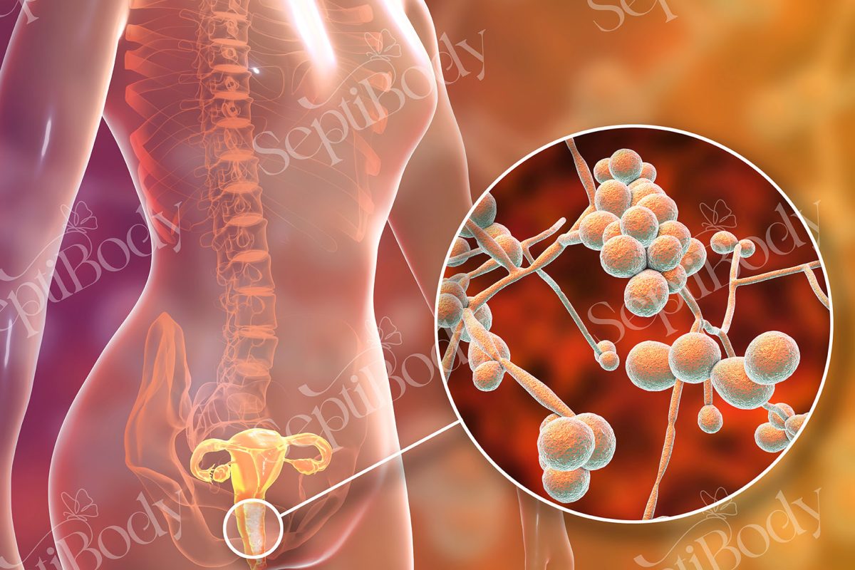 پاکسازی واژن از عفونت